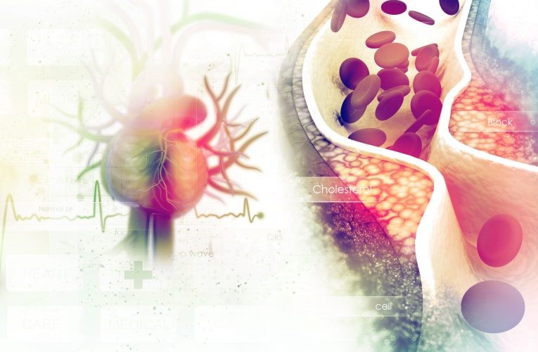 Choroba niedokrwienna serca
Skąd wiesz, że masz wysoki poziom cholesterolu?